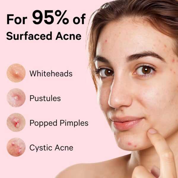 Limited time deal 44% off Sosky  Pimple Patches for Face - Image 5